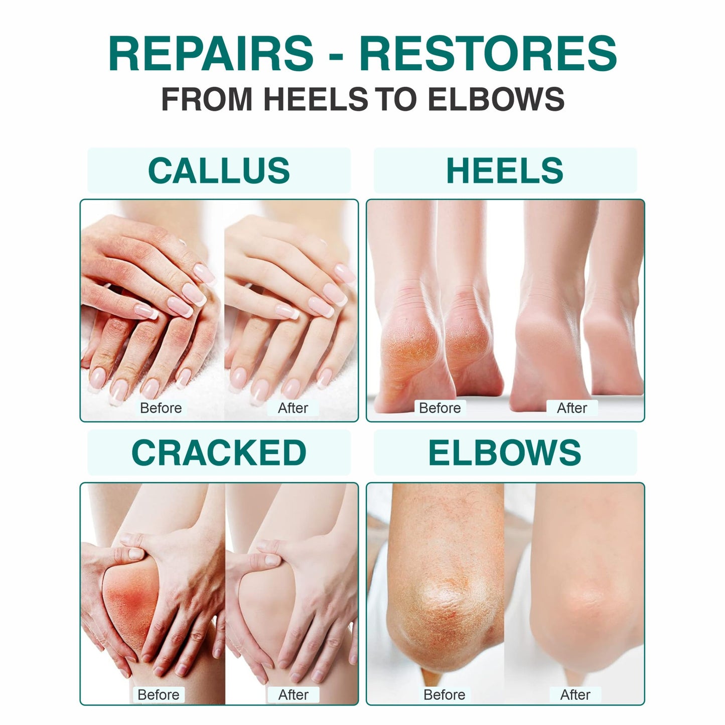 Foot Cream Roll On with 20% Urea – 50ml